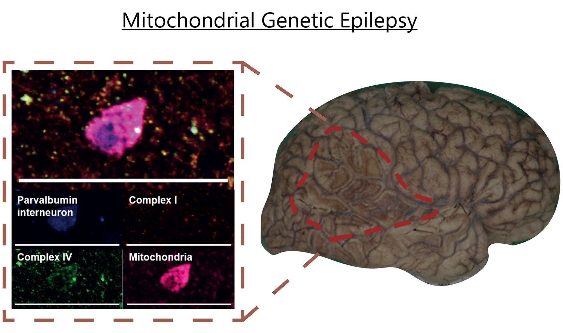 Project 1. MiDAS project (Mitochondrial Dysfunction Associated-Seizures).